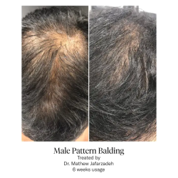 Calecim Advanced Hair System Kit