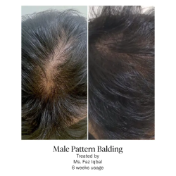 Calecim Advanced Hair System Kit