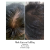 Calecim Advanced Hair System Kit