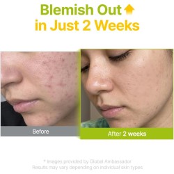 Purito Serum Ácido Azelaico 10 Suero de Té de Koji y Árbol de Té 30ml
