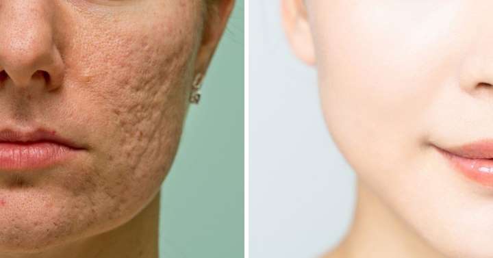 ranura Por favor provocar Como eliminar las manchas del acné - El blog de farmacia Market. Farmacia online noticias y novedades ranura Por favor provocar Como eliminar las manchas del acné - El blog de farmacia Market. Farmacia online noticias y novedades