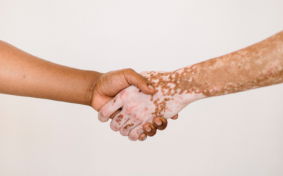 Vitiligo, Que es y posibles tratamientos
