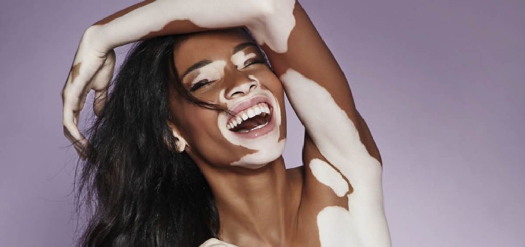  Vitiligo, Que es y posibles tratamientos