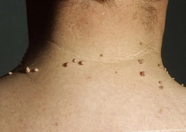 Acrocordones: ¿Cómo eliminar en farmacia?