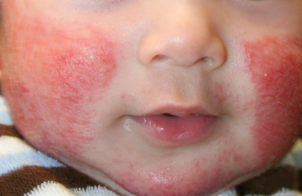 Dermatitis Seborreica en Bebés